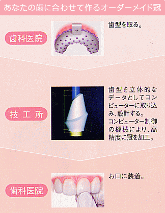 あなたの歯にあわせて作るオーダーメイド冠｜オールセラミック